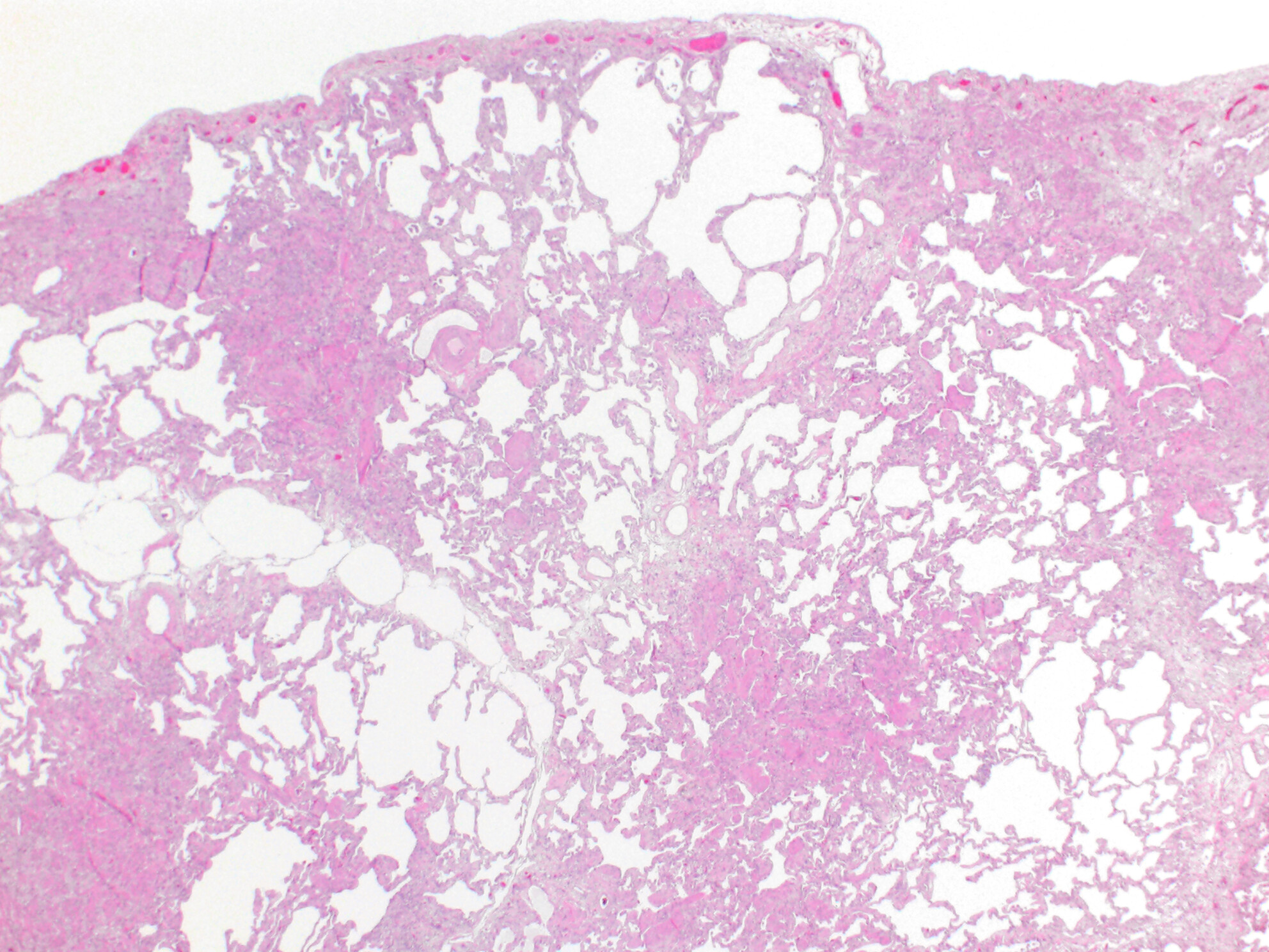 Surgical pathology of diffuse parenchymal lung disease in patients with polymyalgia rheumatica