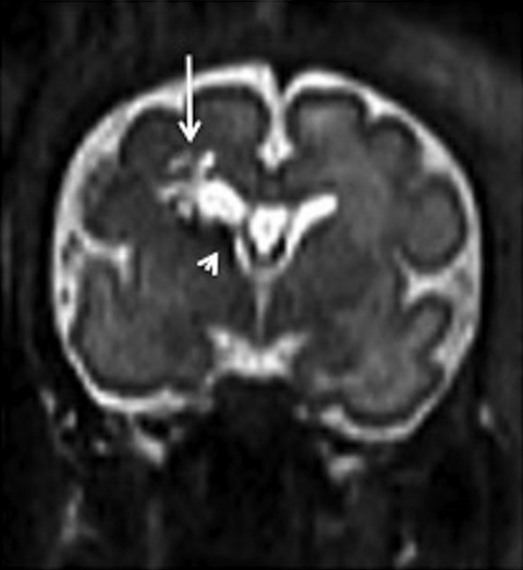Unusual association of brain hemorrhage and digestive tract occlusion: about two prenatal cases