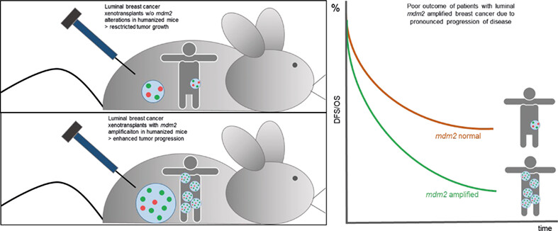 mdm2 gene amplification is associated with luminal breast cancer progression in humanized PDX mice and a worse outcome of estrogen receptor positive disease