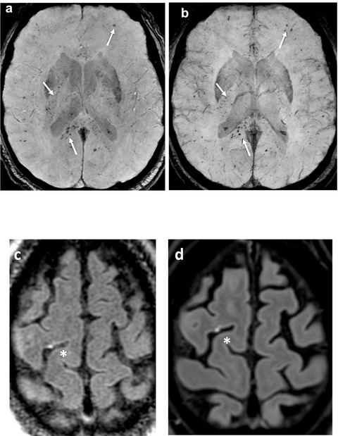 Acute-onset delirium in intensive care COVID patients: association of imperfect brain repair with foodborne micro-pollutants