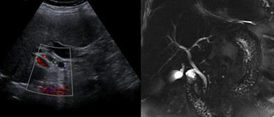 Diagnostic accuracy of ultrasonography compared with magnetic resonance cholangiopancreatography in the detection of choledocholithiasis