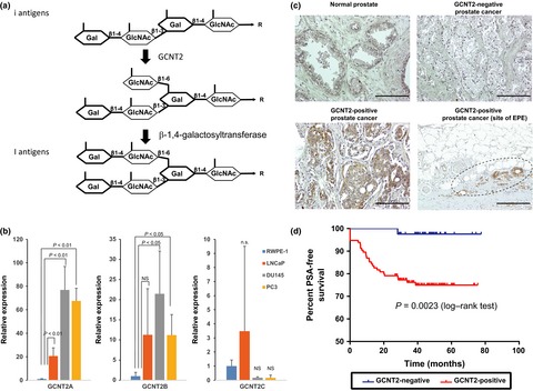 I-branching N-acetylglucosaminyltransferase regulates prostate cancer invasiveness by enhancing α5β1 integrin signaling