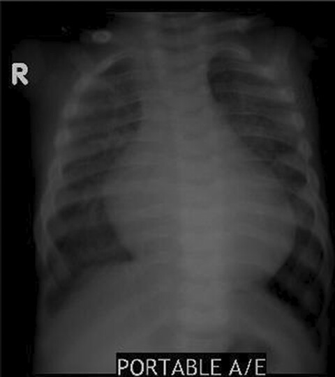 Alpha-L-iduronidase deficiency: A novel mutation resulting in severe early presentation of Mucopolysaccharidosis type I and literature review of the molecular basis