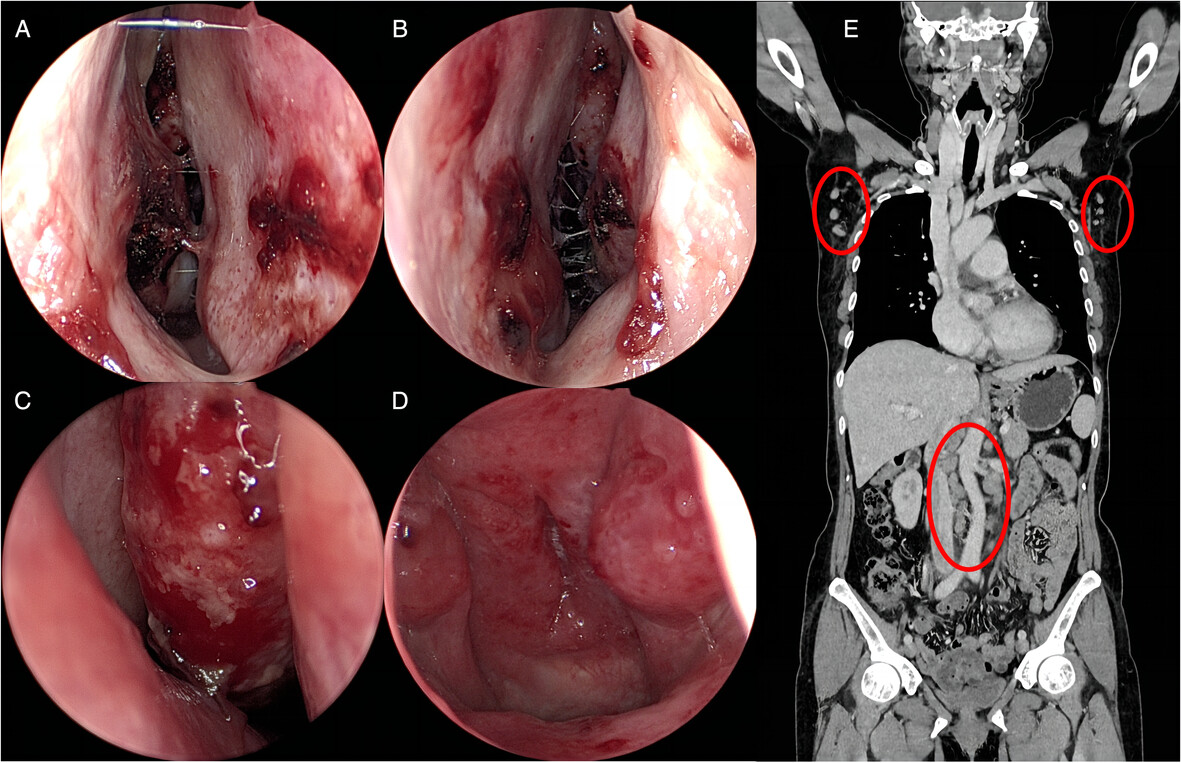 Lymphoplasmacytic Lymphoma/Waldenström Macroglobulinemia Diagnosed Following Recurrent Epistaxis
