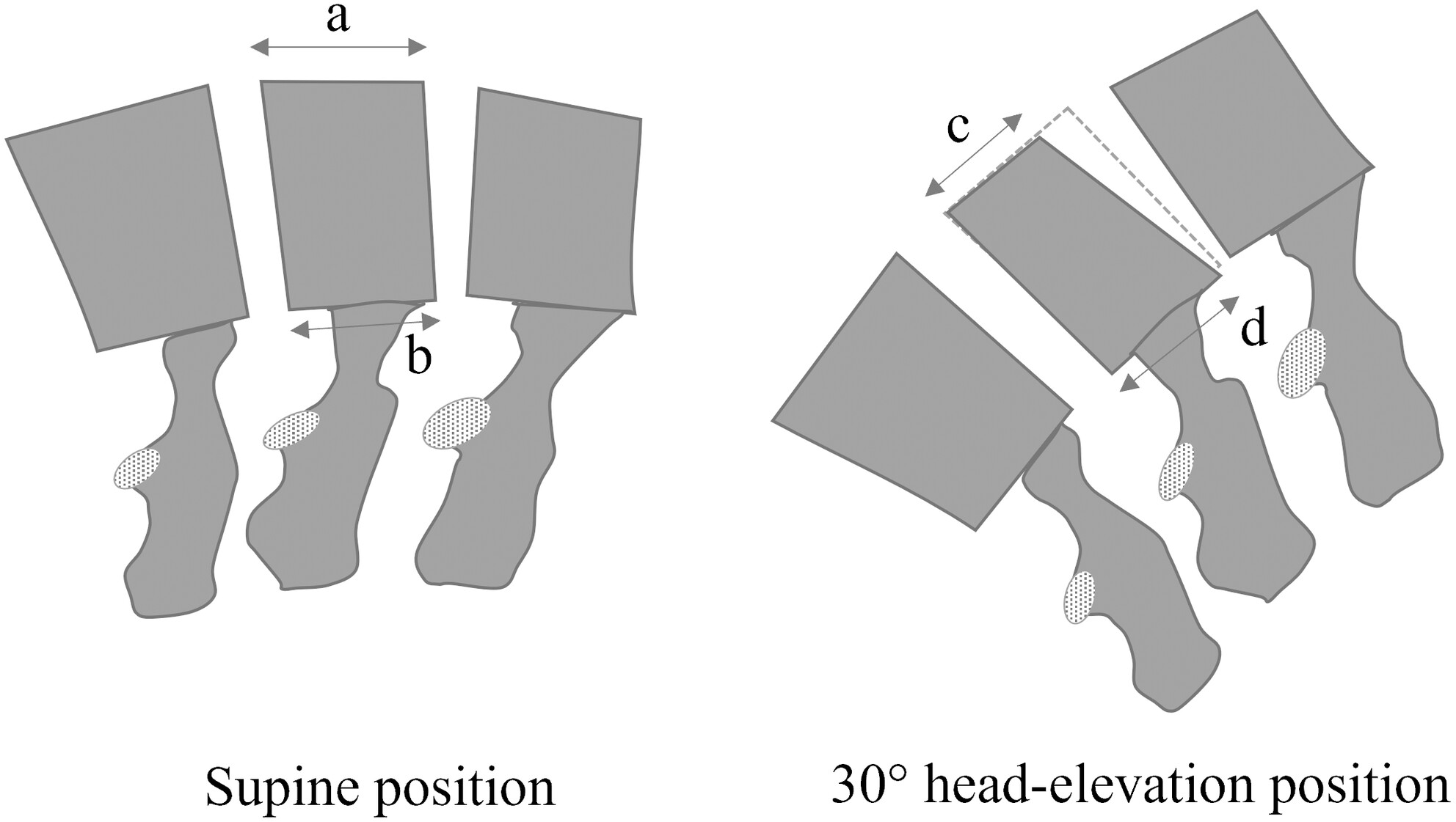 A novel radiological assessment to identify acute vertebral compression fractures: A pilot observational study