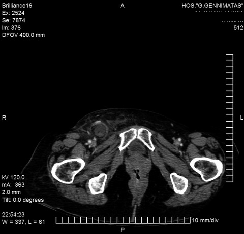 Α very rare case of De Garengeot’s hernia: Acute appendicitis within a femoral hernia