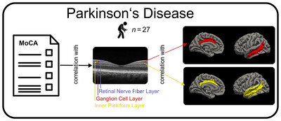 Cognition-Associated Changes in Retinal Thickness Relate to Limbic and Temporal Cortical Atrophy in Parkinson's Disease