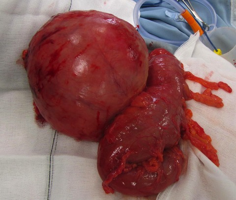 Giant diverticulum- A rare complication of a common surgical condition