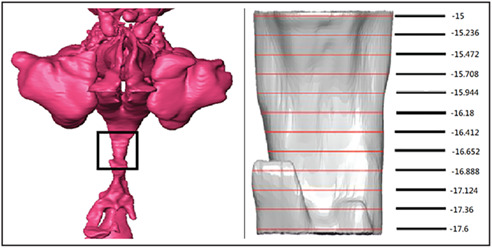 Pharyngeal distensibility during expiration is an independent predictor of the severity of obstructive sleep apnoea