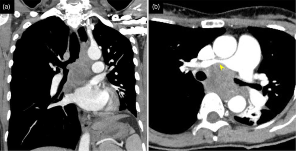 Successful use of extracorporeal membrane oxygenation for airway-obstructing lung adenocarcinoma