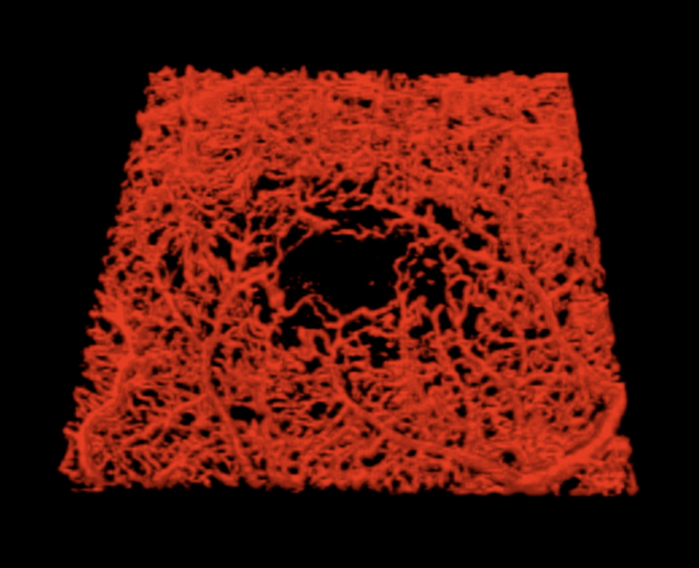 Quantification of diabetic macular ischemia using novel three-dimensional optical coherence tomography angiography metrics