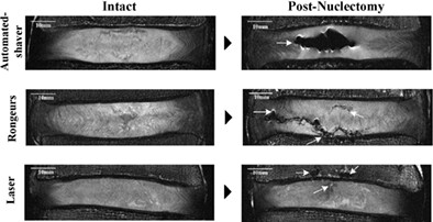 An in vitro comparison of three nucleus pulposus removal techniques for partial intervertebral disc replacement: An ultra-high resolution MRI study