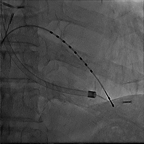 Predictors of lead break during transvenous lead extraction