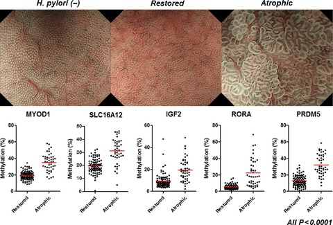 Morphologic characterization of residual DNA methylation in the gastric mucosa after Helicobacter pylori eradication