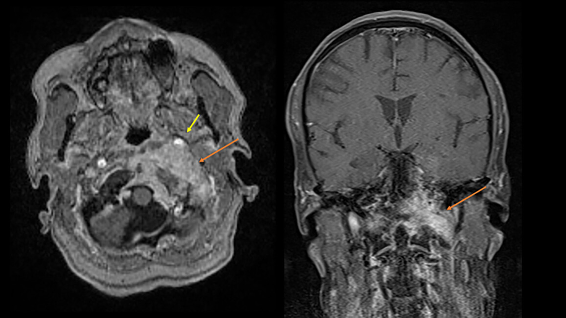 Granulomatous Inflammation of the Skull Base: A Rare Case of Mycobacterium tuberculosis in the United States