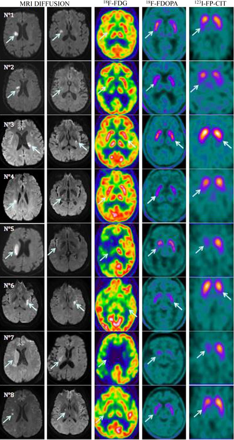 Stroke-related restless legs syndrome: Clinical and anatomo-functional characterization of an emerging entity