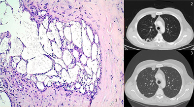 Unprecedented long-term survival in a patient with malignant pleural mesothelioma treated with subsequent systemic chemo- and immunotherapeutic regimens