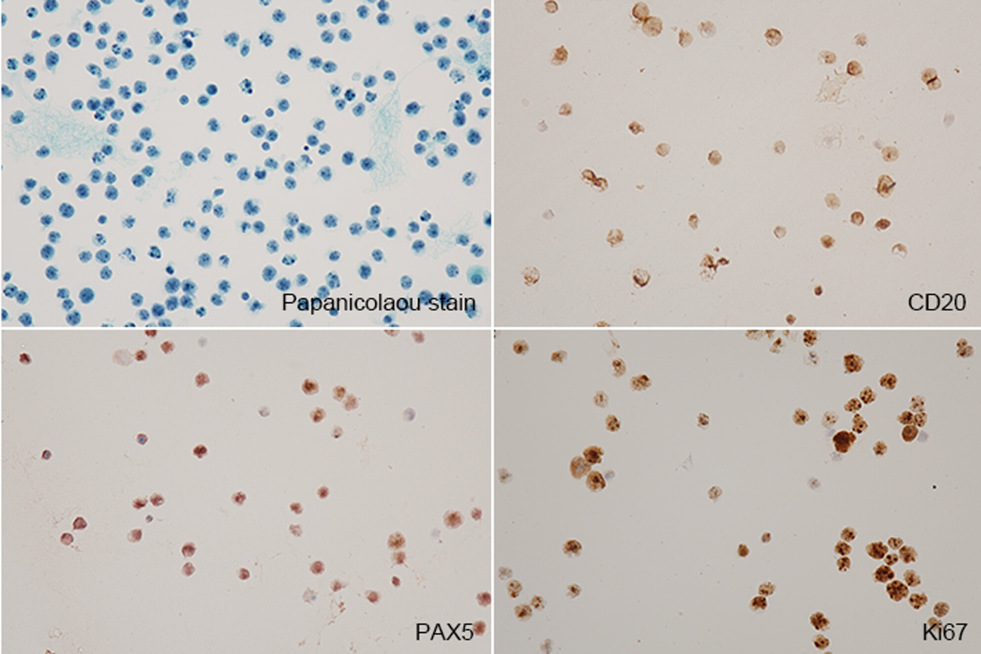 A case report of primary central nervous system lymphoma with immune deficiency/disorder setting diagnosed by cerebrospinal fluid cytology