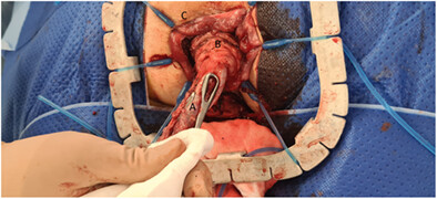 How to do a Delorme's sleeve mucosectomy and muscular plication for full-thickness rectal prolapse