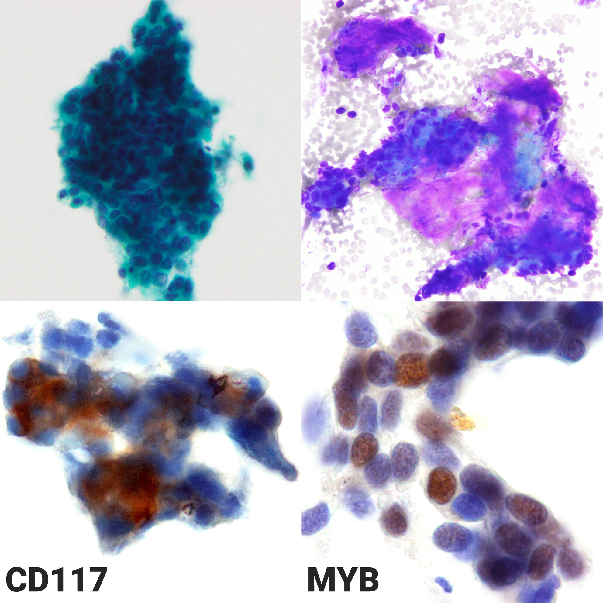 Unusual Pancreatic Metastasis of Solid Subtype Adenoid Cystic Carcinoma: Reappraisal of MYB and CD117 Immunostaining Utility in Liquid-Based Cytology