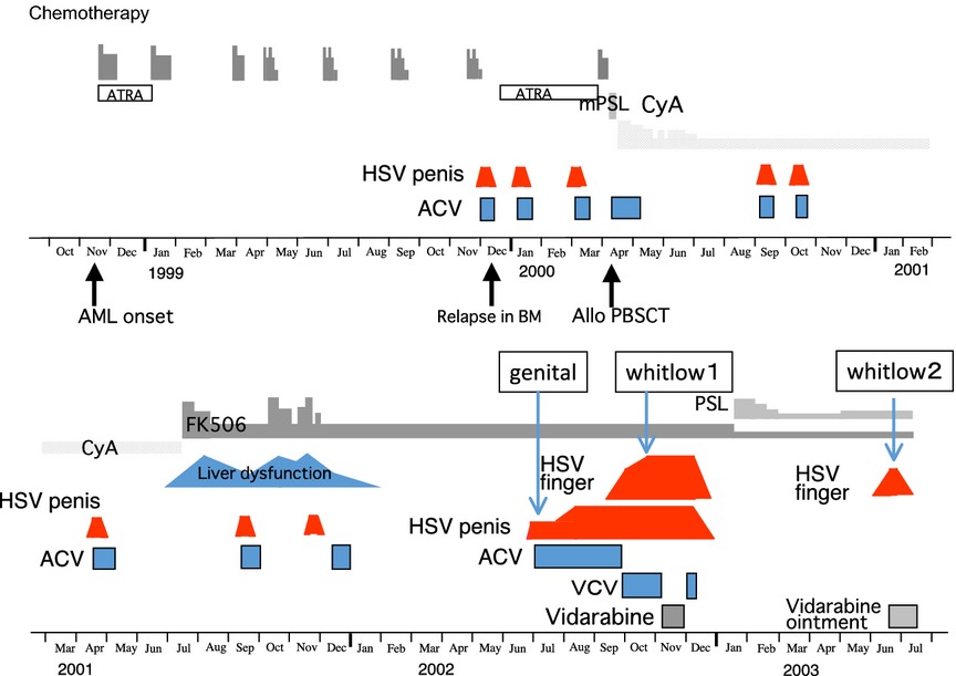 Identification of ribonucleotide reductase mutation causing temperature-sensitivity of herpes simplex virus isolates from whitlow by deep sequencing