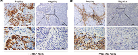 Identification of an IDO1-based immune classifier for survival prediction of upper tract urothelial carcinoma