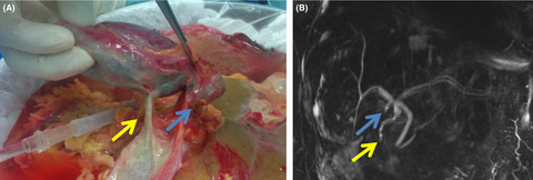 Hepaticocholecystic duct: A pitfall of cholecystectomy