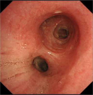 Complete response of squamous cell carcinoma of the lung following treatment with pembrolizumab in an elderly patient: A case report