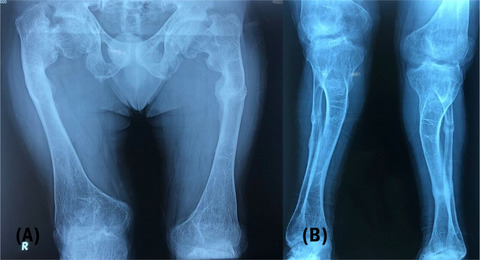 X-linked hypophosphatemic rickets: Case report of late diagnosis and bone pain improvement with targeted treatment