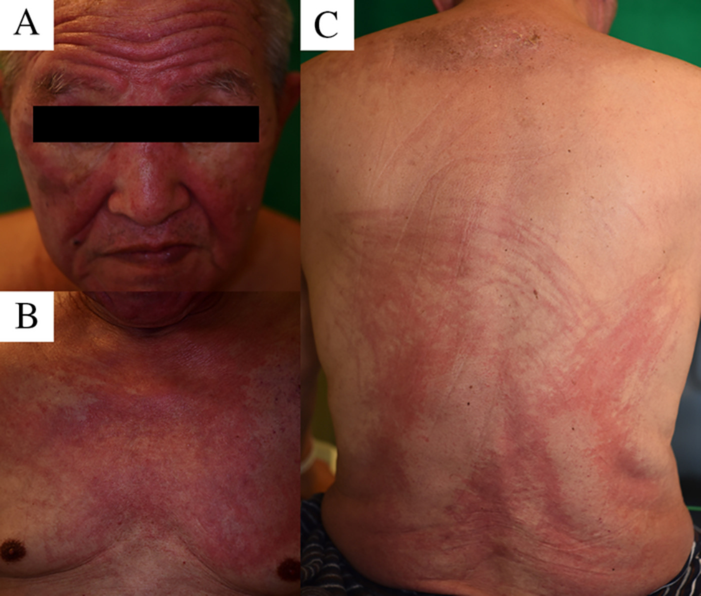 Anti-TIF1γ antibody-positive dermatomyositis associated with durvalumab administration in a patient with lung and oesophageal cancers