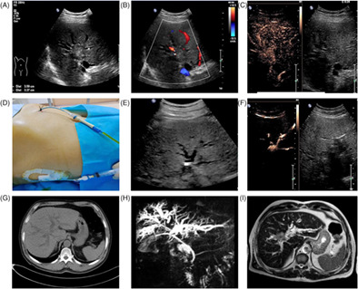 Intravenous combined with intrabiliary contrast-enhanced ultrasound in the evaluation of resectability of hilar cholangiocarcinomas