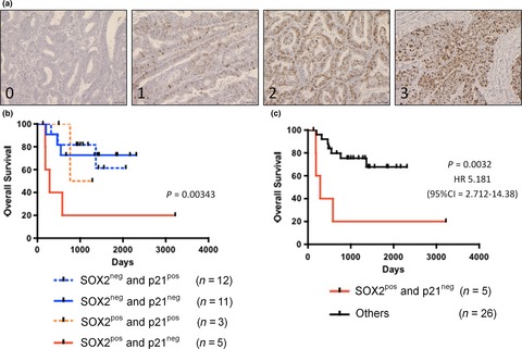Sox2-dependent inhibition of p21 is associated with poor prognosis of endometrial cancer