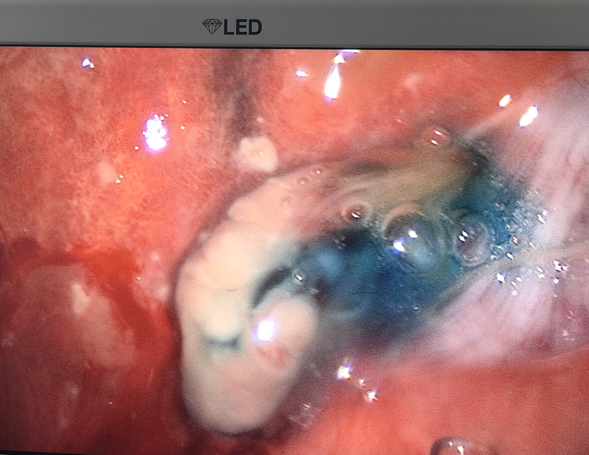 Bronchoscopic-Guided Selective Endobronchial Injection of Methylene Blue Solution for Localising Peripheral Bronchopleural Fistulas During Pleural Debridement in a Post-Lobectomy Patient With Bronchopleural Fistula and Empyema