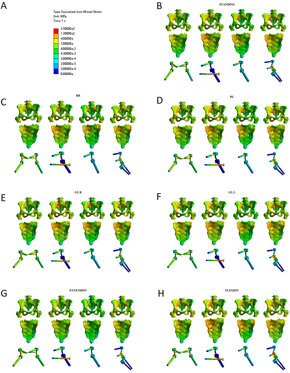 Unilateral Lumbo-Pelvic Fixation for Denis Type I Unilateral Sacral Fracture: A Finite Element Analysis
