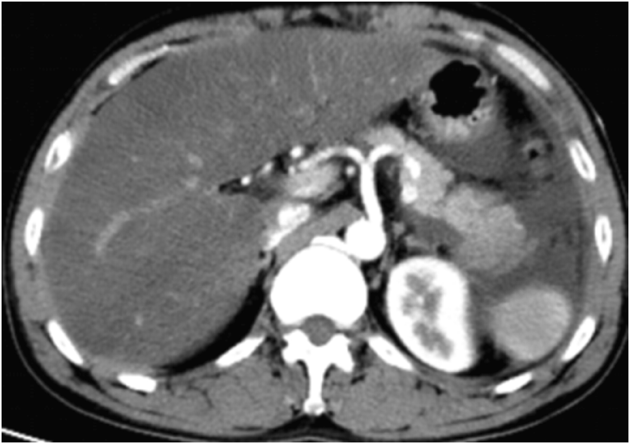Development of a Joint Prediction Model for Assessing the Severity of Hypertriglyceridemia-Induced Acute Pancreatitis Issue ,
