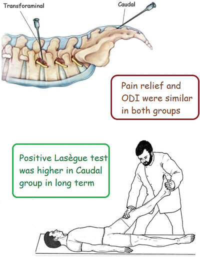 Comparison of Clinical Effects and Physical Examination of Transforaminal and Caudal Steroid Injection With Targeted Catheter in Lumbar Radiculopathy: A Single-Blind Randomized Clinical Trial