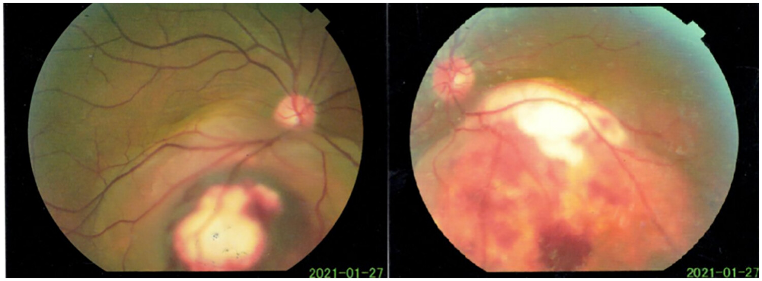 Rapid vision improvement by using icotinib in a patient with bilateral choroidal metastases symmetrically from lung cancer