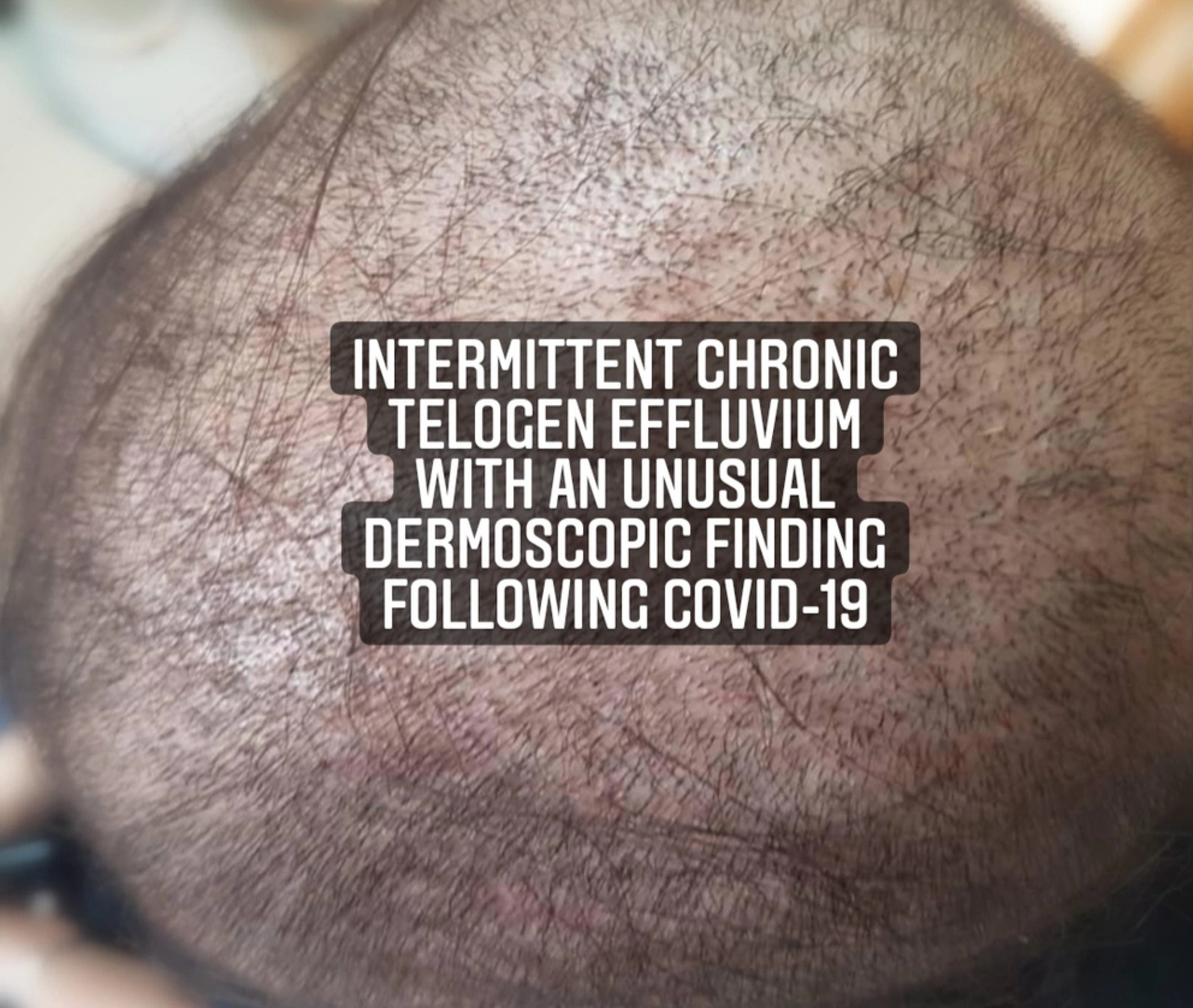 Intermittent chronic telogen effluvium with an unusual dermoscopic finding following COVID-19