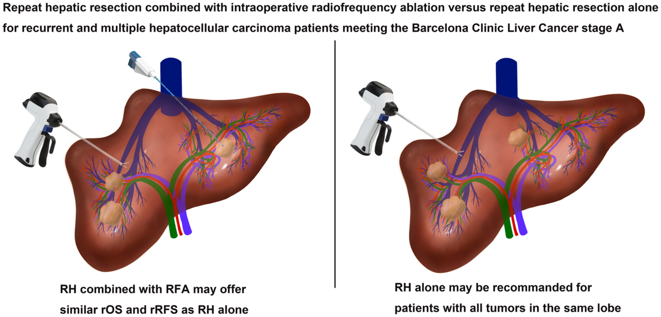 Repeat hepatic resection combined with intraoperative radiofrequency ablation versus repeat hepatic resection alone for recurrent and multiple hepatocellular carcinoma patients meeting the Barcelona Clinic Liver Cancer stage A: A propensity score-matched analysis