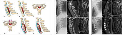 Anterior Controllable Antedisplacement and Fusion (ACAF) vs Posterior Laminoplasty for Multilevel Severe Cervical Ossification of the Posterior Longitudinal Ligament: Retrospective Study Based on a Two-Year Follow-up