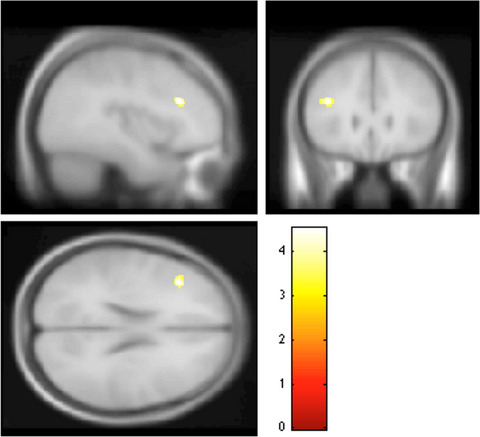 Neural correlates of verbal recognition memory in obese adults with and without major depressive disorder