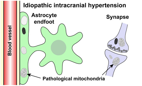 Increased occurrence of pathological mitochondria in astrocytic perivascular endfoot processes and neurons of idiopathic intracranial hypertension