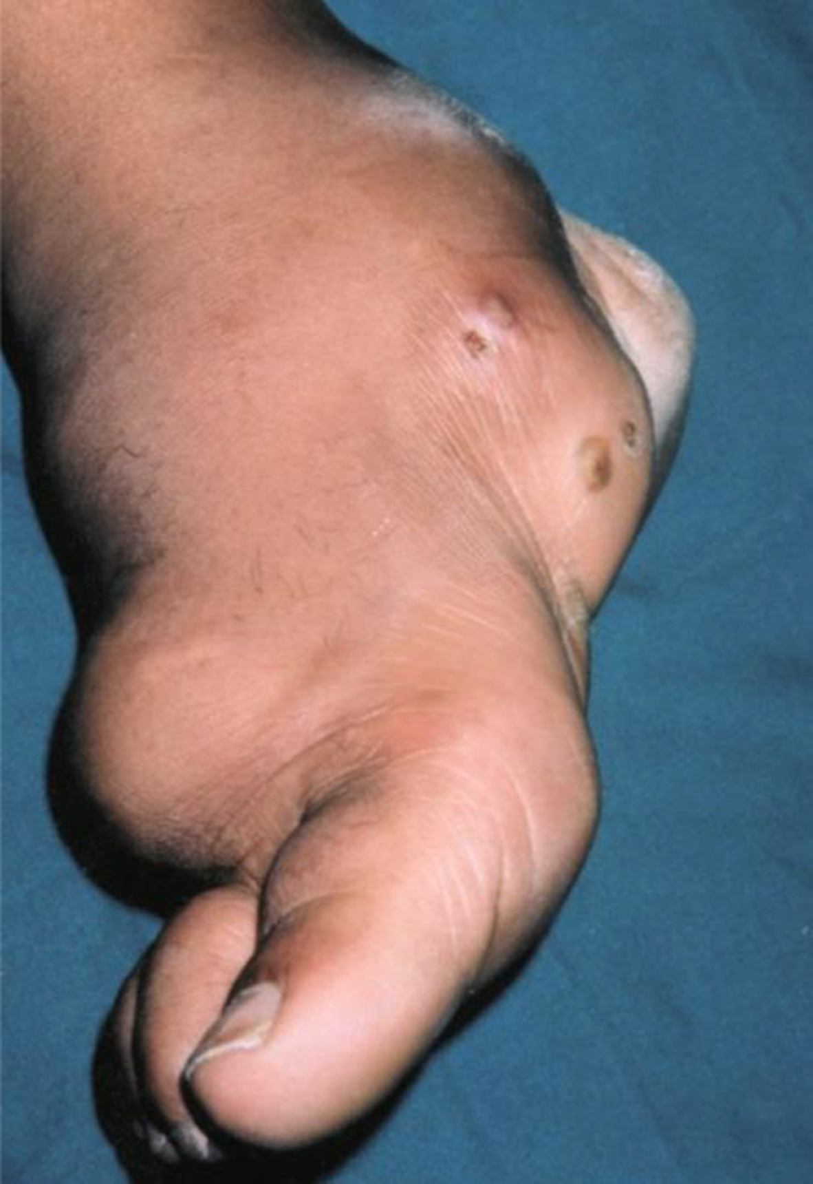 Eumycotic mycetoma involving the right foot: A new Tunisian case