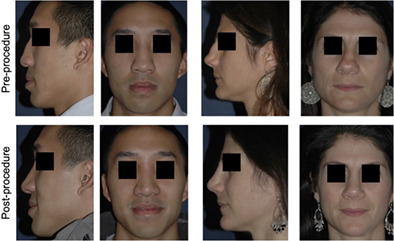 Review of literature of saddle nose deformity reconstruction and presentation of vomer onlay graft