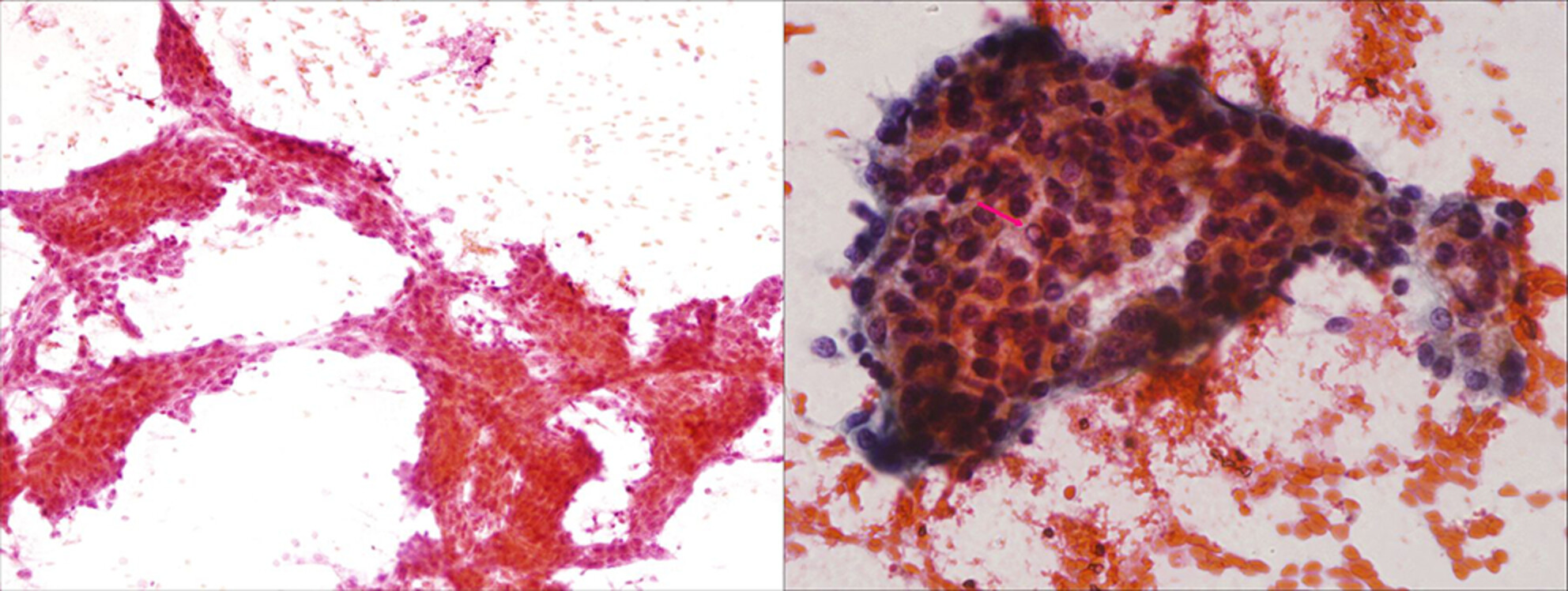Cytomorphology of paediatric hepatocellular carcinoma: A useful diagnostic adjunct