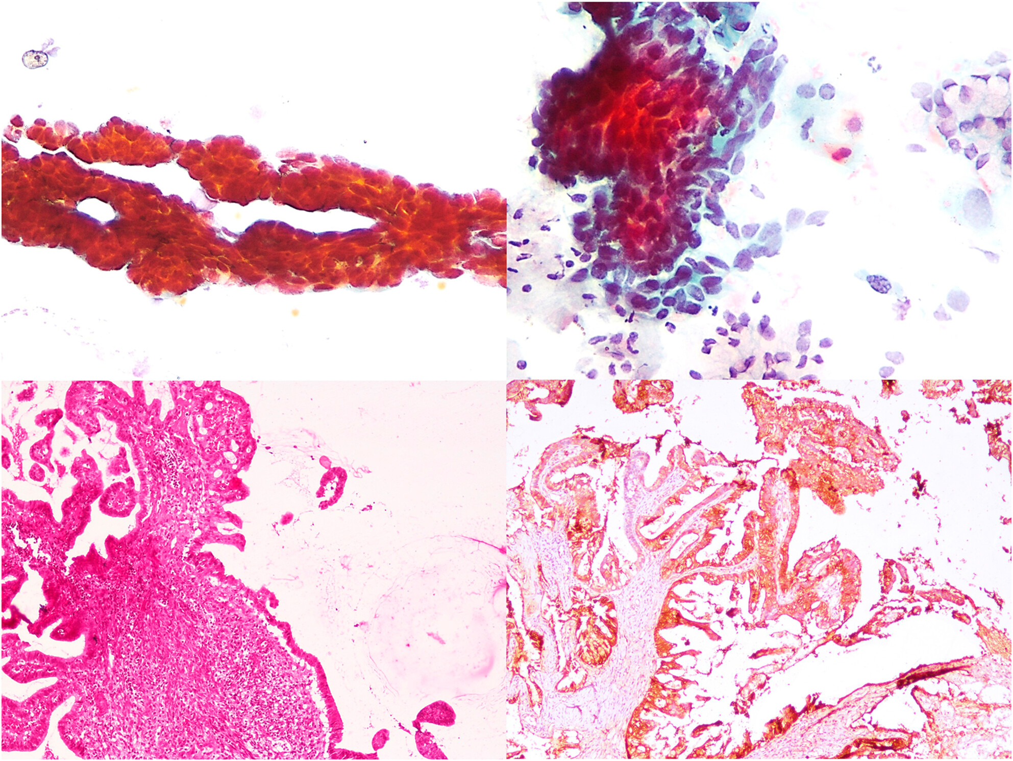 Villoglandular Carcinoma of the Uterine Cervix: Clinic-Cytopathological-Histological Features of a Rare Case With Brief Review of the Literature