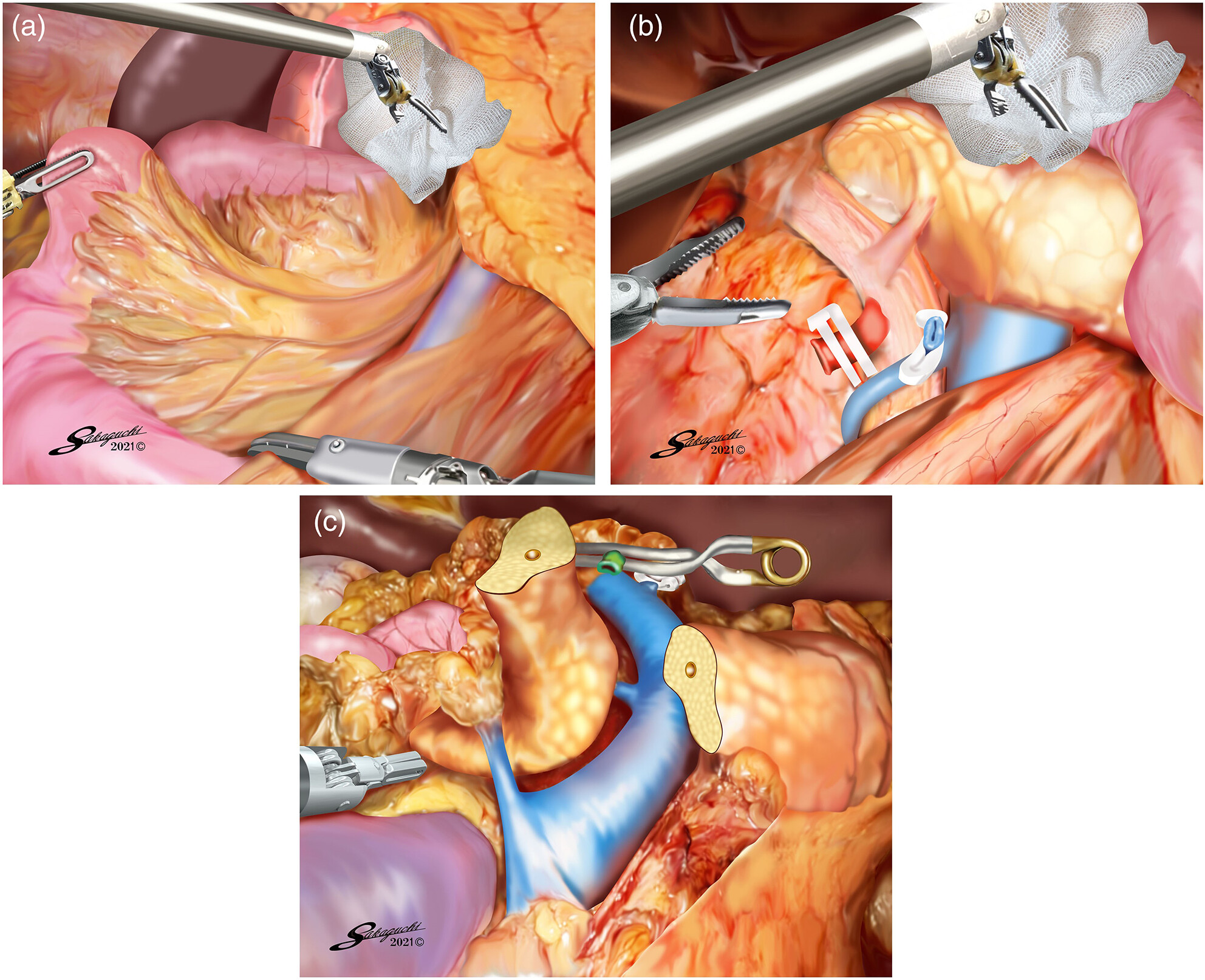 Right lateral approach to the superior mesenteric artery in robotic pancreaticoduodenectomy