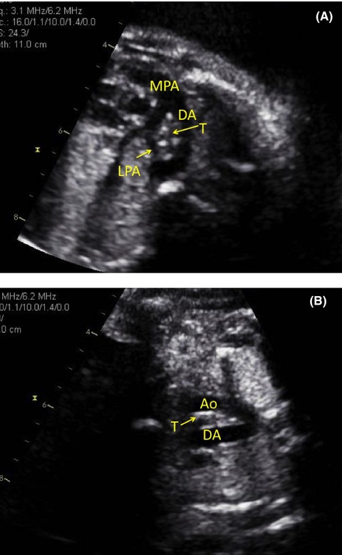 Double trouble: fetal diagnosis of a pulmonary artery sling and vascular ring
