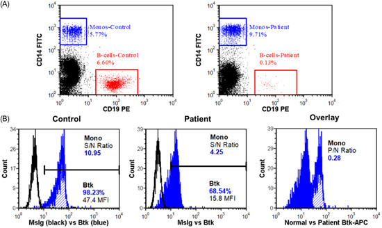 Investigation of a synonymous mutation in Btk in a patient with agammaglobulinemia: A case report