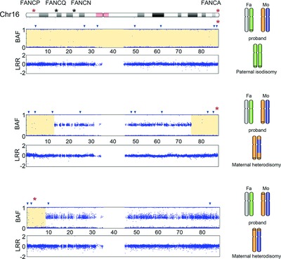 Paternal or Maternal Uniparental Disomy of Chromosome 16 Resulting in Homozygosity of a Mutant Allele Causes Fanconi Anemia